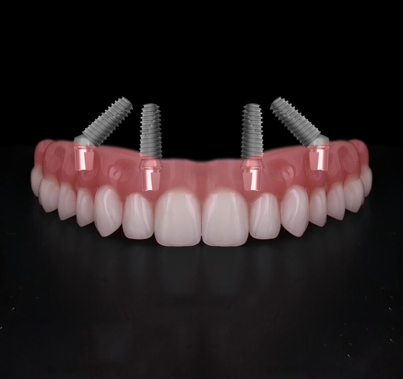 am i suitable for all on four dental implants